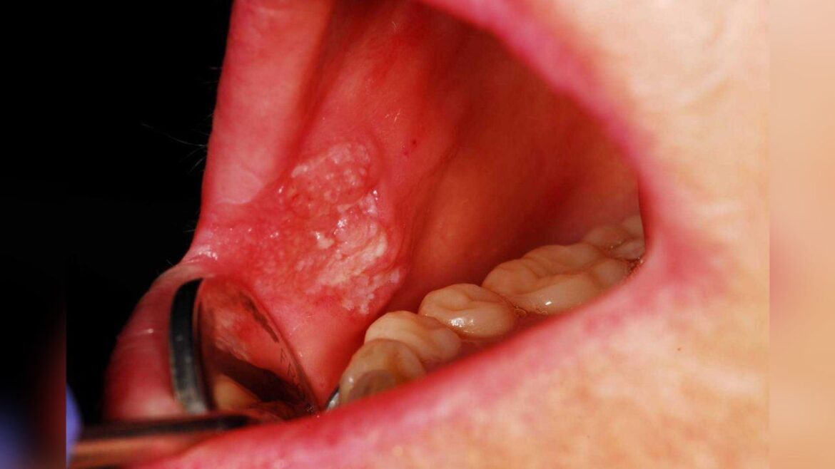 17.4 peratus pesakit kanser mulut di Malaysia dari Sabah