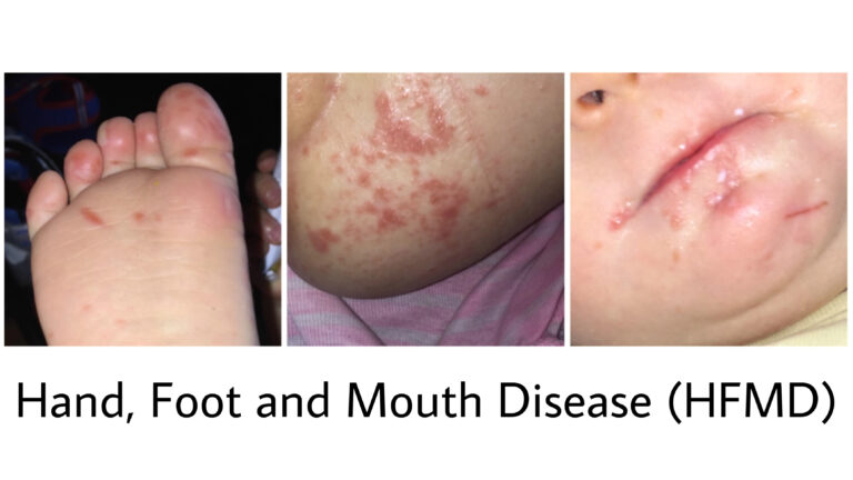 hfmd